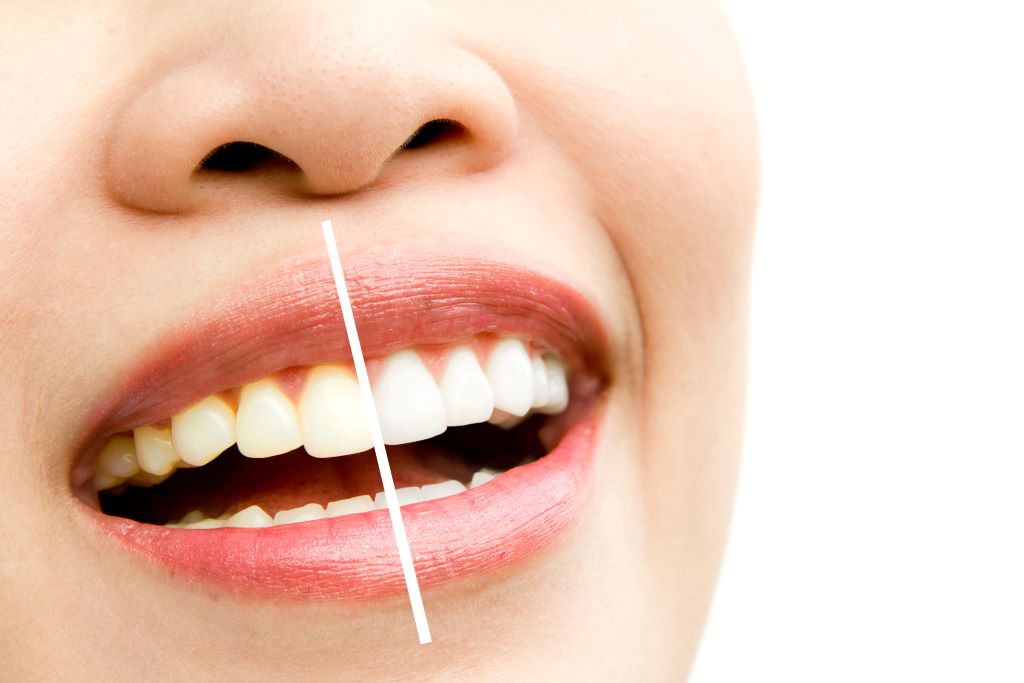 teeth whitening in lawrenceville ga