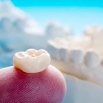 Benefits of cosmetic crowns