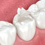 what are the advantages and disadvantages of inlay and onlay procedures