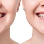the importance of replacing missing teeth after extraction