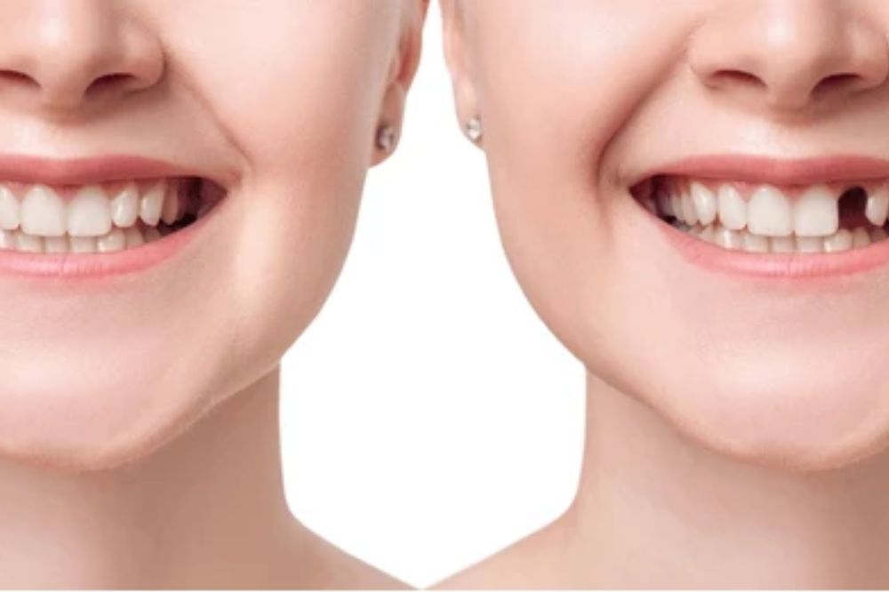 the importance of replacing missing teeth after extraction