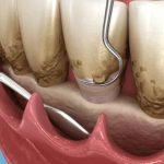 the importance of scaling and root planing for gum health