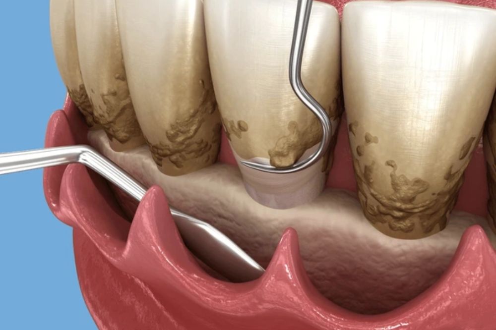 the importance of scaling and root planing for gum health