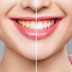 Teeth Whitening Myths Busted
