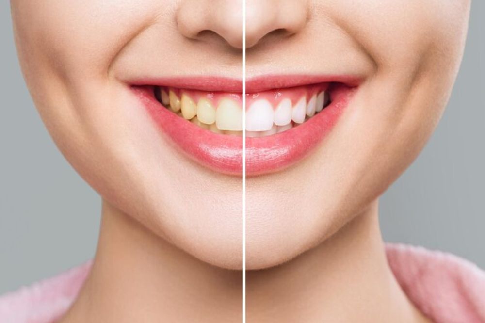 Teeth Whitening Myths Busted