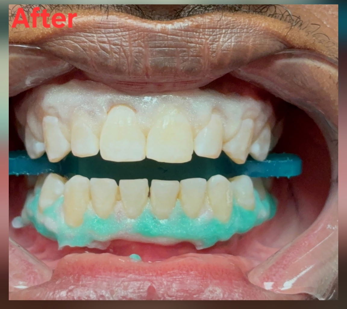 Whiter teeth. Brighter confidence