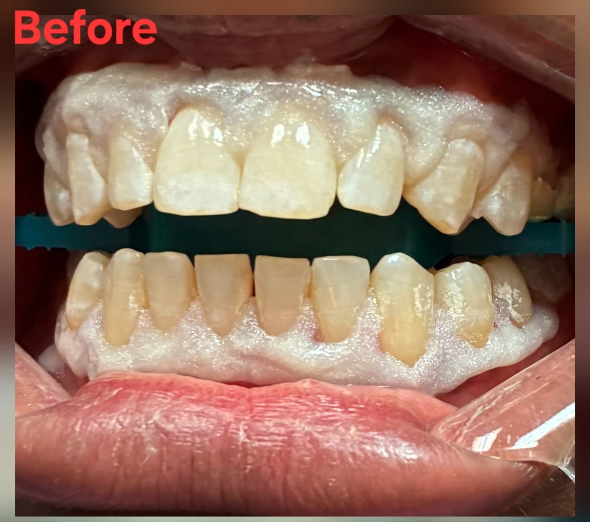 Whiter teeth. Brighter confidence