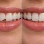 can cosmetic bonding repair chipped front teeth
