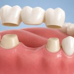 how dental bridges help prevent teeth from shifting