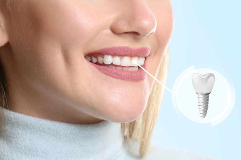 Single Implant