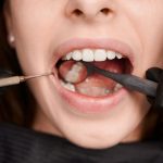 can you eat right after a dental filling