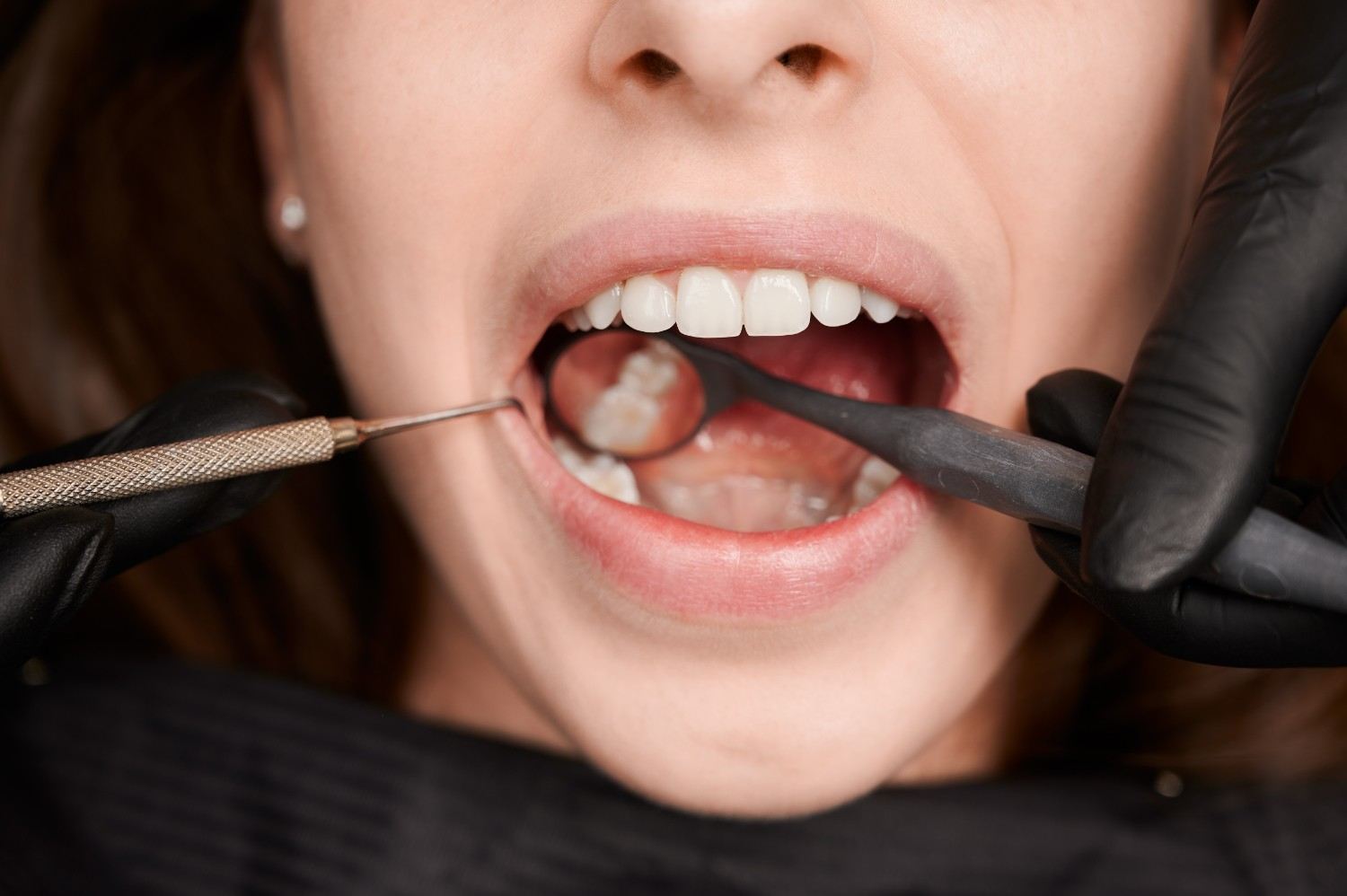 can you eat right after a dental filling